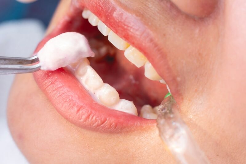 Fluoride Treatment for Kids Rigby